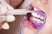 Blanchissement des dents par un dentiste